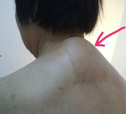 富贵包治疗视频,告别颈肩不适的康复指南