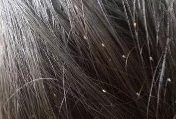 梳虱子视频,梳虱子视频教程